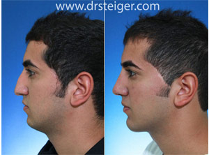rhinoplasty with chin implant man