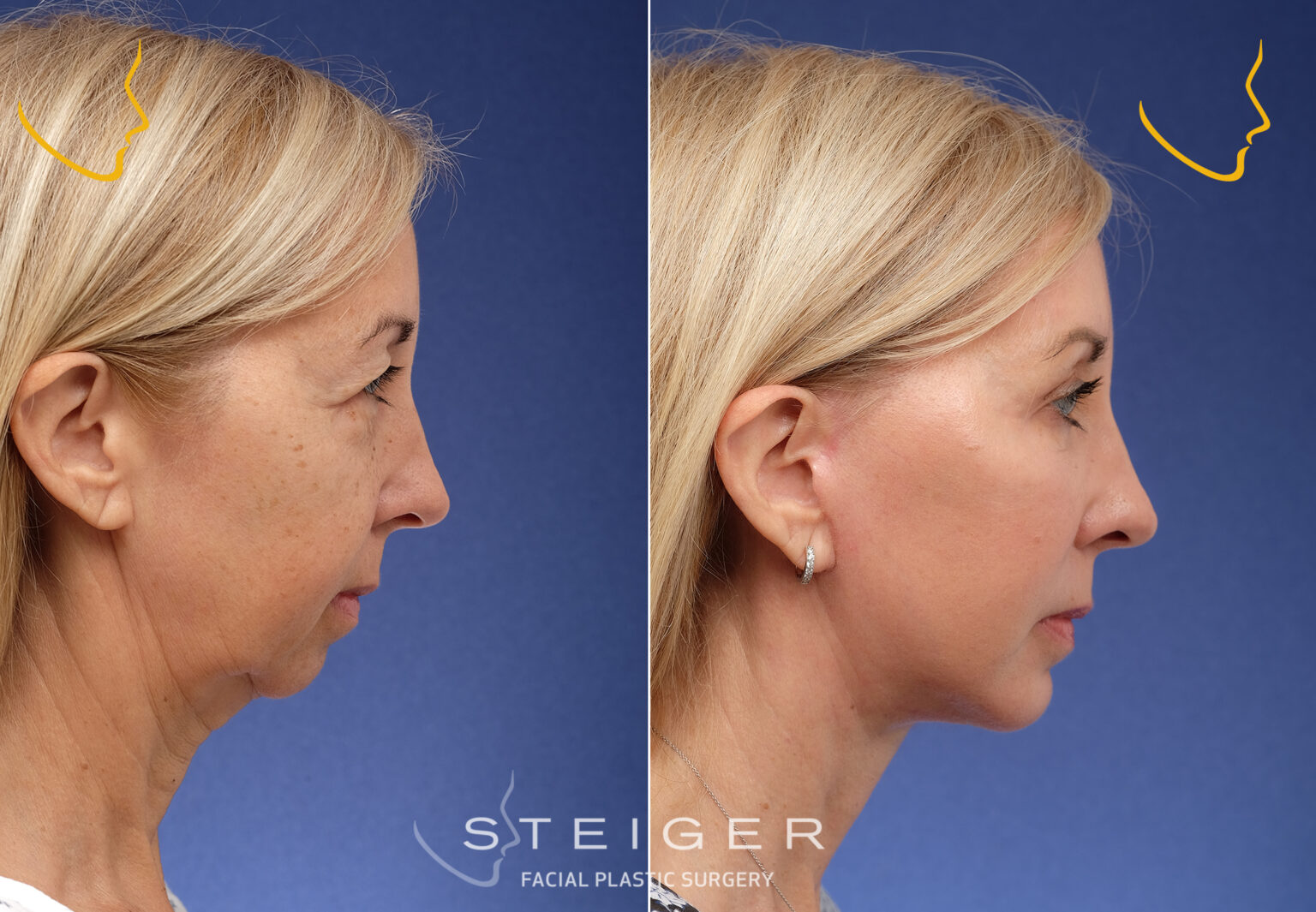 Facelift Before And After Photos Deep Plane Facelift deep-plane-facelifts-before-after-photos-from-dr-kevin-sadati