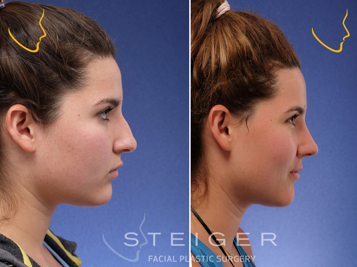 Rhinoplasty Advanced Nose Job Specialist in Boca Raton Florida