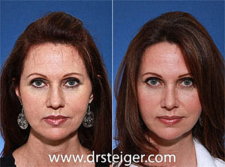 South Florida Rhinoplasty Surgery