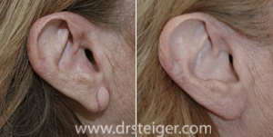 Earlobe Repair Surgery, Miami, FL