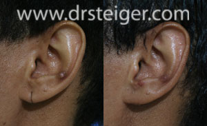 split-ear-lobe-repair