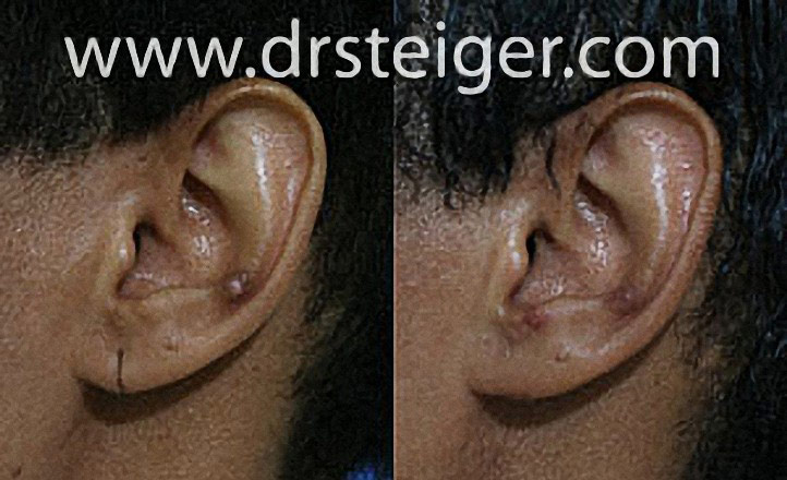 split-ear-lobe-repair1