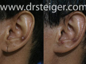 split-ear-lobe-repairs