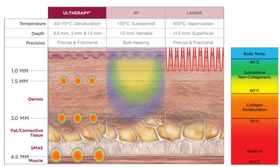 How does ultherapy work | Steiger Facial Plastic Surgery | Boca Raton ...