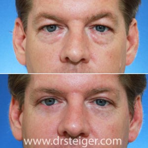 upper-and-lower-blepharoplasty-pictures