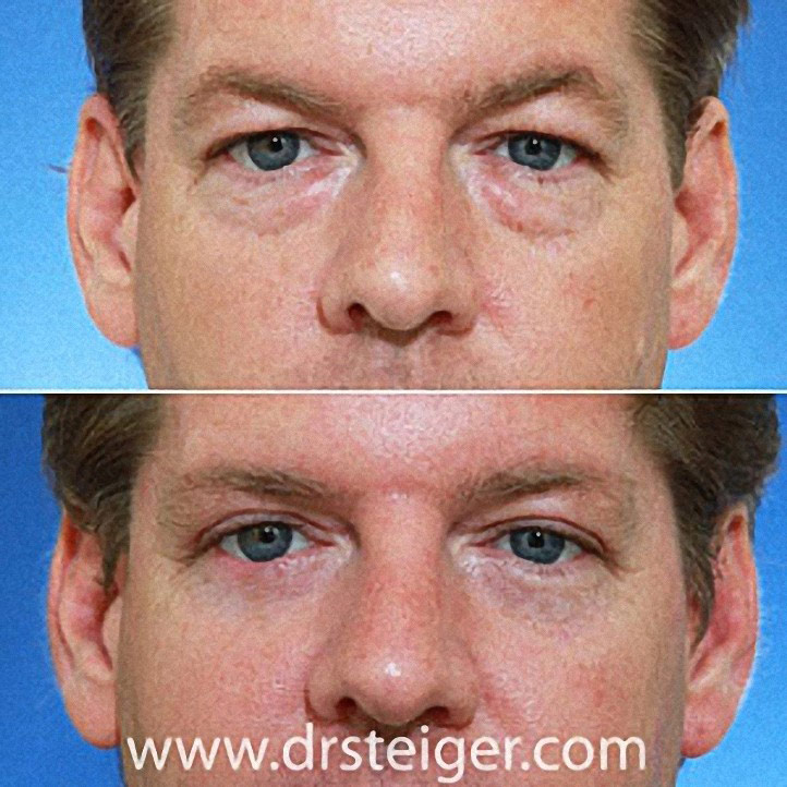 upper-and-lower-blepharoplasty-pictures1