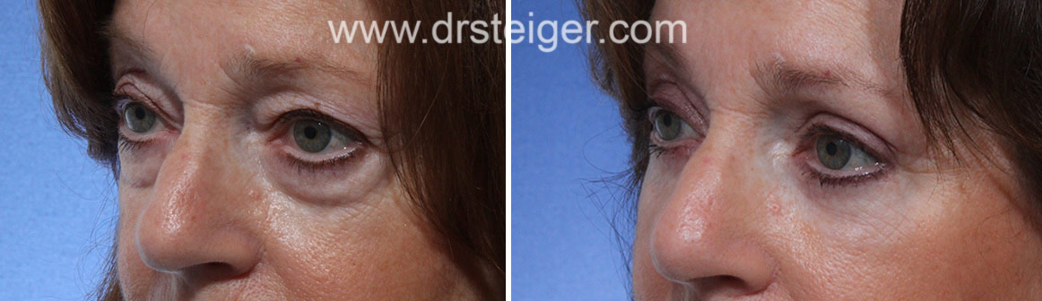Upper and Lower Eyelid Surgery South Florida