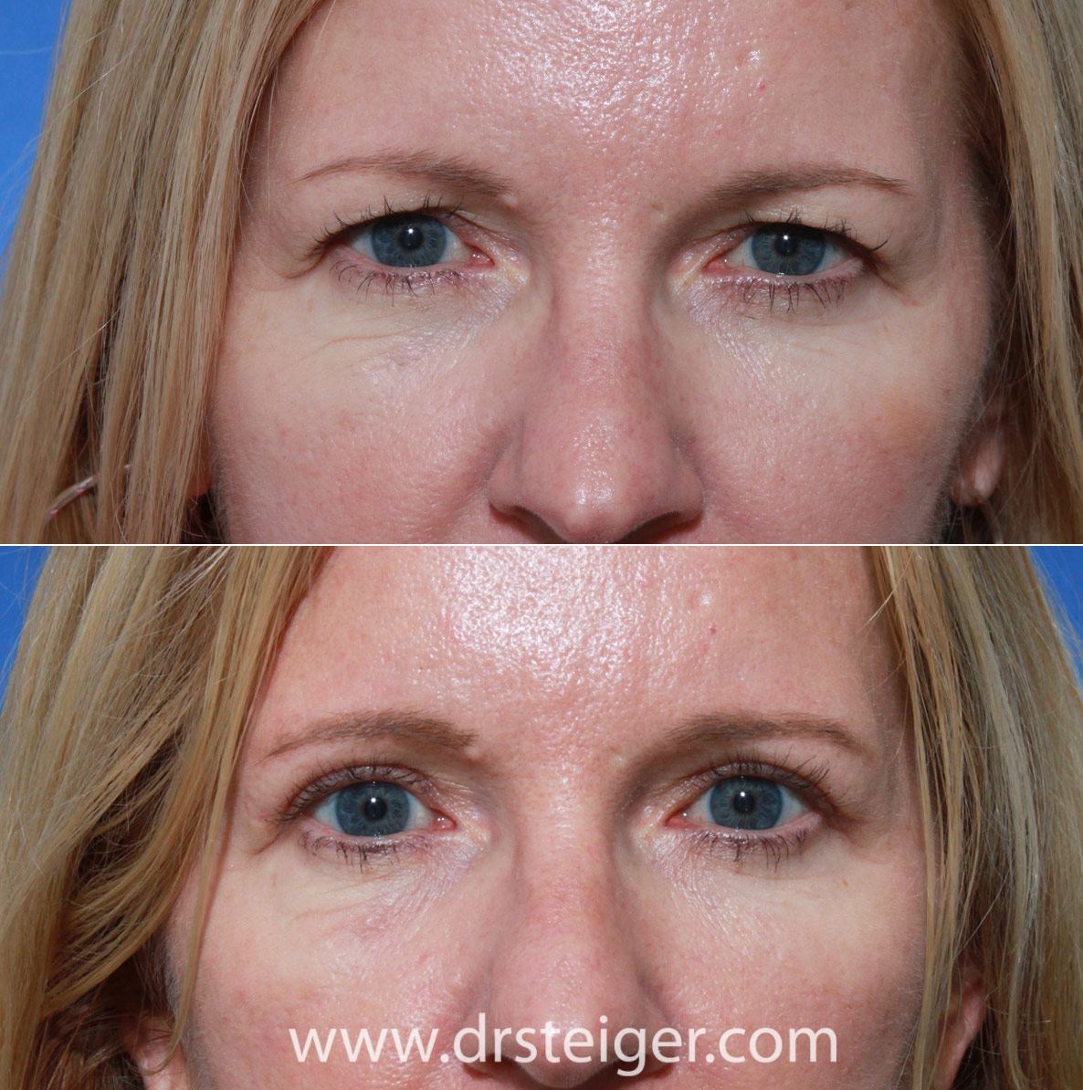 blepharoplasty before and after young