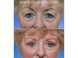 upper blepharoplasty surgery pictures