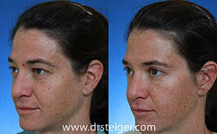 Upper Eyelid Surgery Before And After1 Steiger Facial Plastic Surgery Boca Raton Facelift 