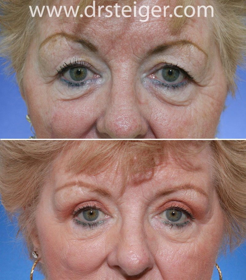 Blepharoplasty Eyelid Surgery Photos Before And After