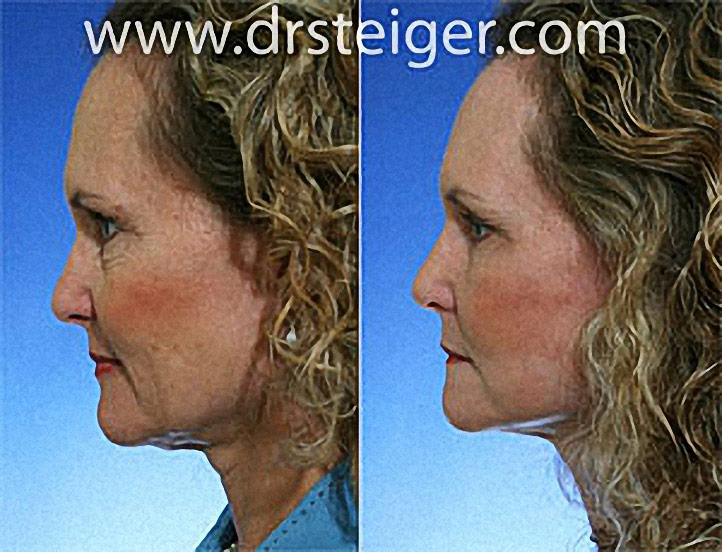 verticalfaceliftbeforeandafter1 Steiger Facial Plastic Surgery