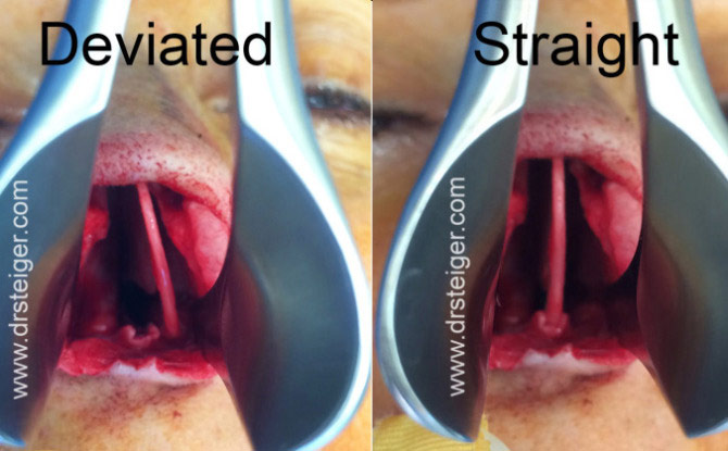 deviated septum surgery bruising