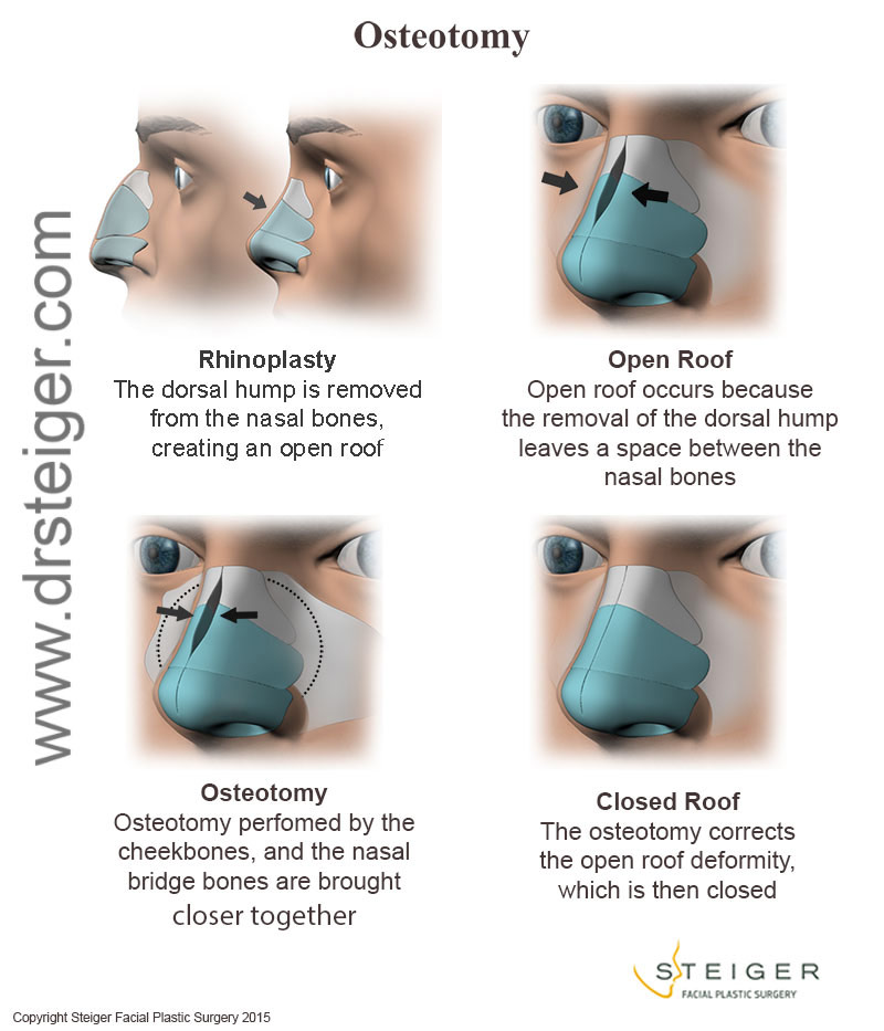 rhinoplasty break the nose